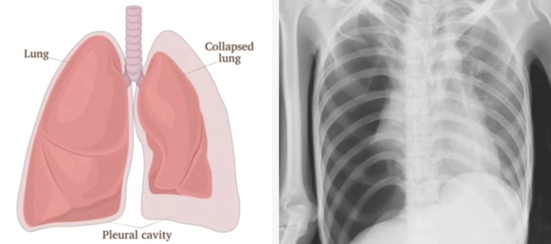 기흉 증상에 대한 글의 이해를 돕기 위한 이미지 : 이 이미지의 좌측은 기흉 상태의 폐 모습을 그림으로 나타내고 있으며, 우측은 이러한 상태의 x-ray 사진을 보여주고 있습니다.